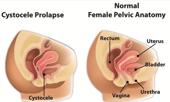 Problems with the pelvic floor