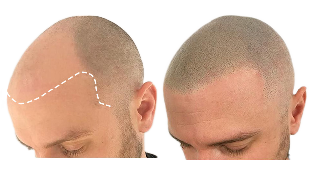 hair-tattoo-hair-hair-loss-hair-micropigmentation